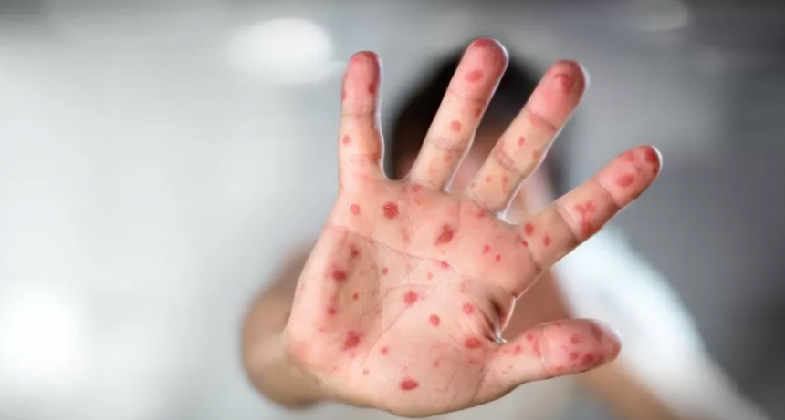 El Ministerio de Salud confirmó el primer caso sospechoso de viruela del mono en la Argentina
