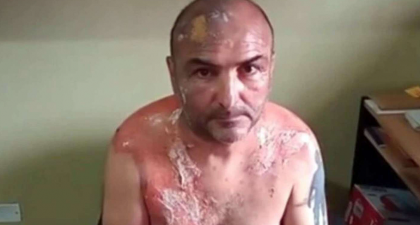 Denunció que su exesposa le tiró agua hirviendo cuando se estaban separando