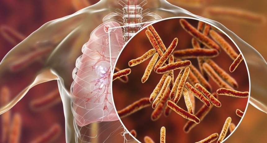 La OMS advirtió que subieron las muertes por tuberculosis